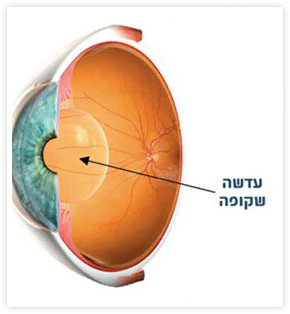 ניתוח קטרקט החלמה