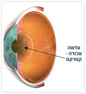 עדשה עכורה קטרקט